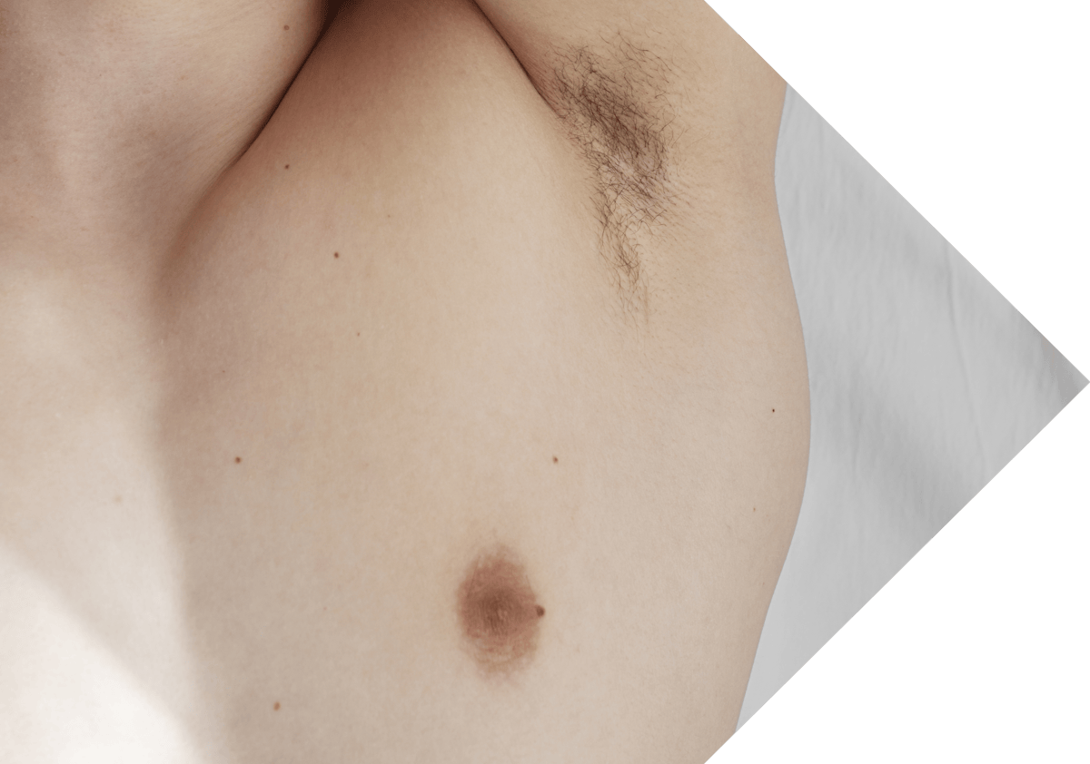 man with an intimate skin tag on his nipple area