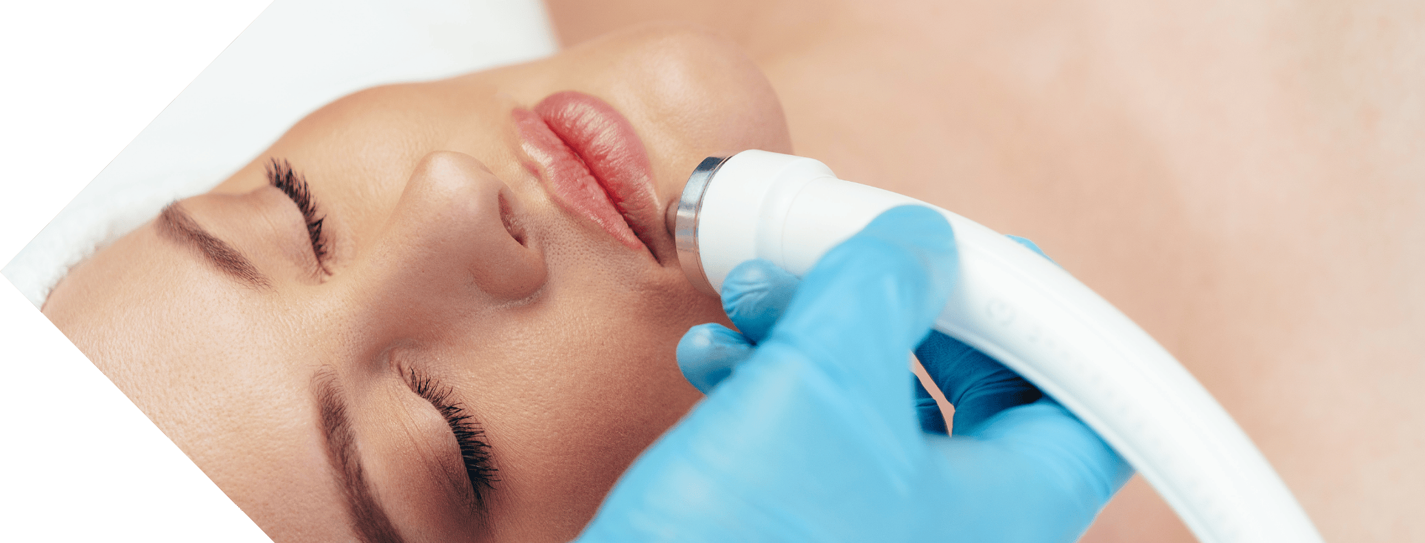 a woman having cryopen treatment