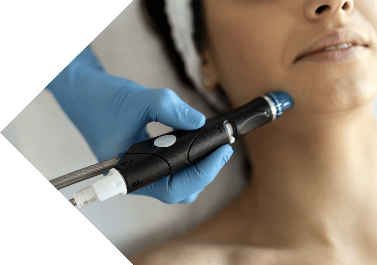 cryopen treatment being performed on a woman