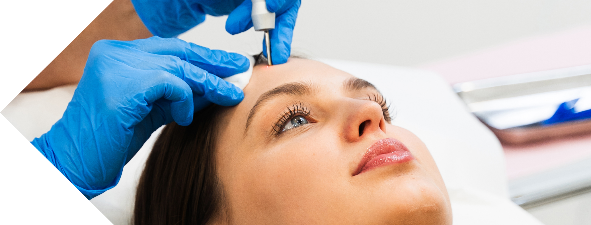 woman having skin tag removal with cryopen