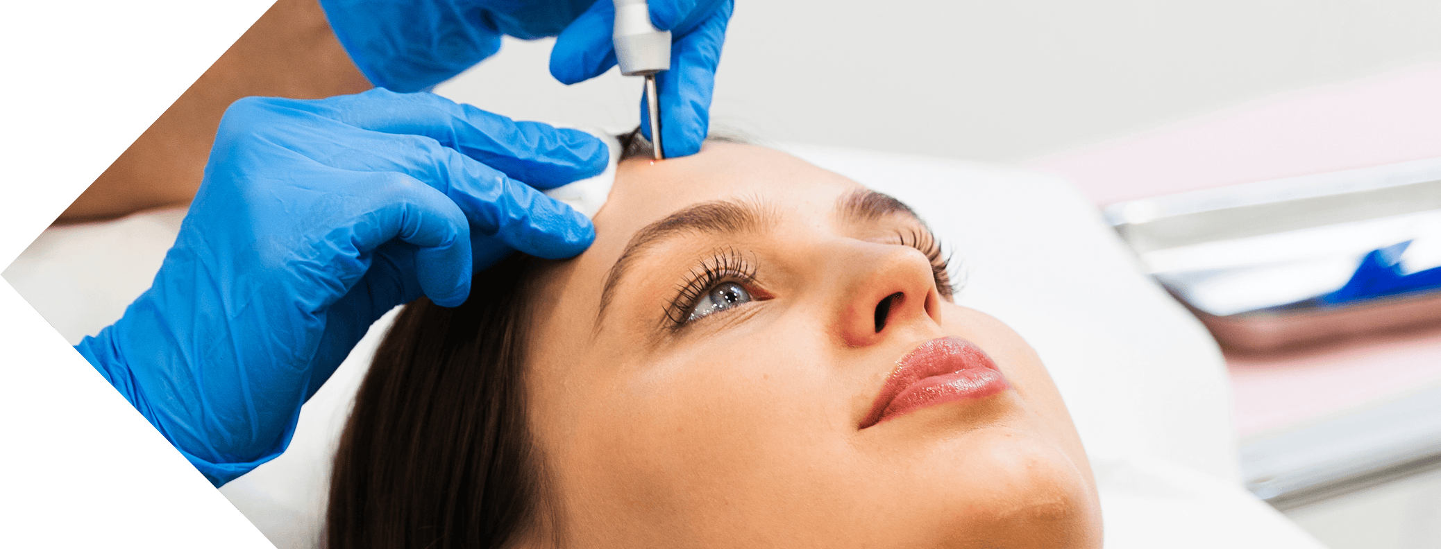 woman having skin tag removal with cryopen