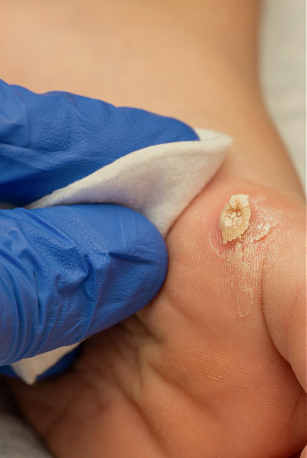 A foot with a wart being removed
