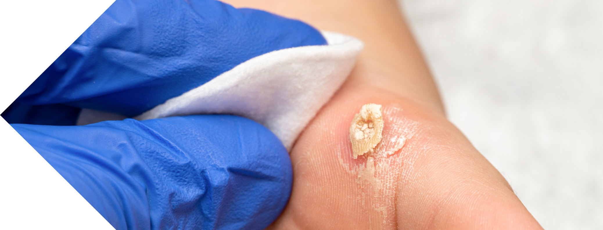A foot with a wart being removed