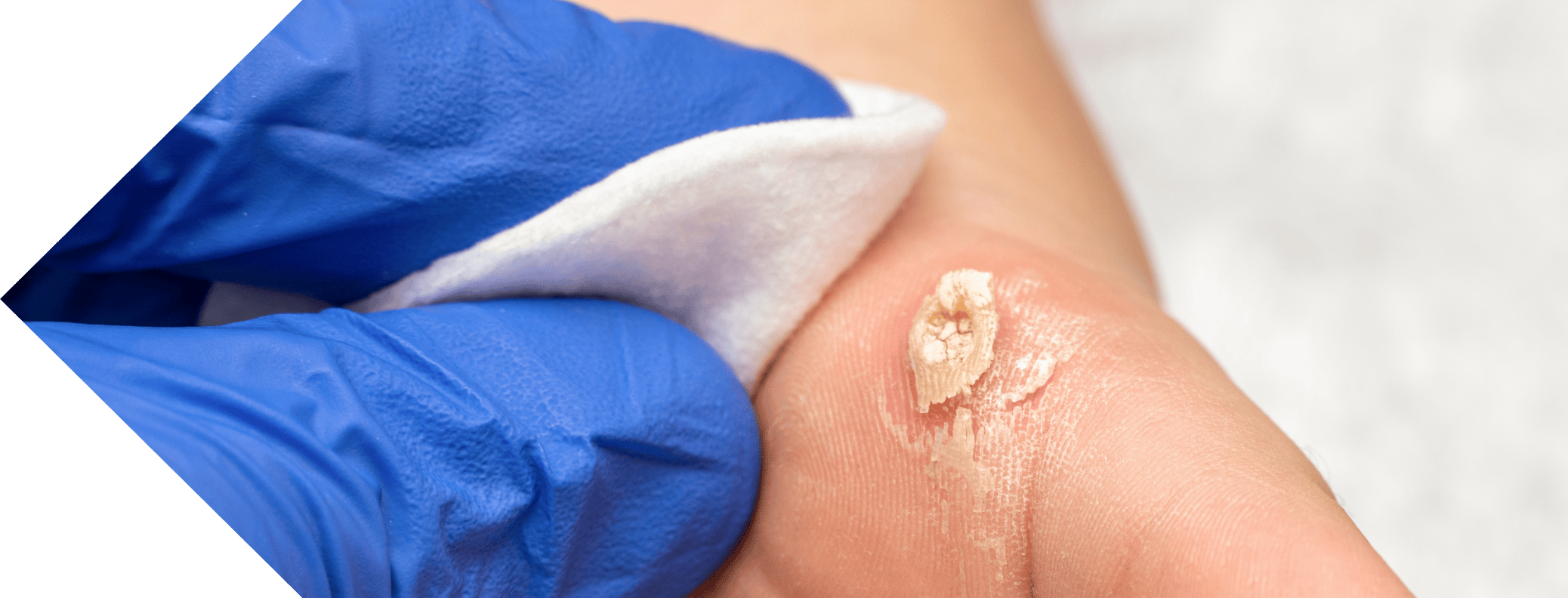 A foot with a wart being removed