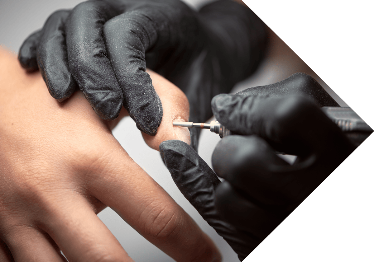 A wart being treated with Cryopen