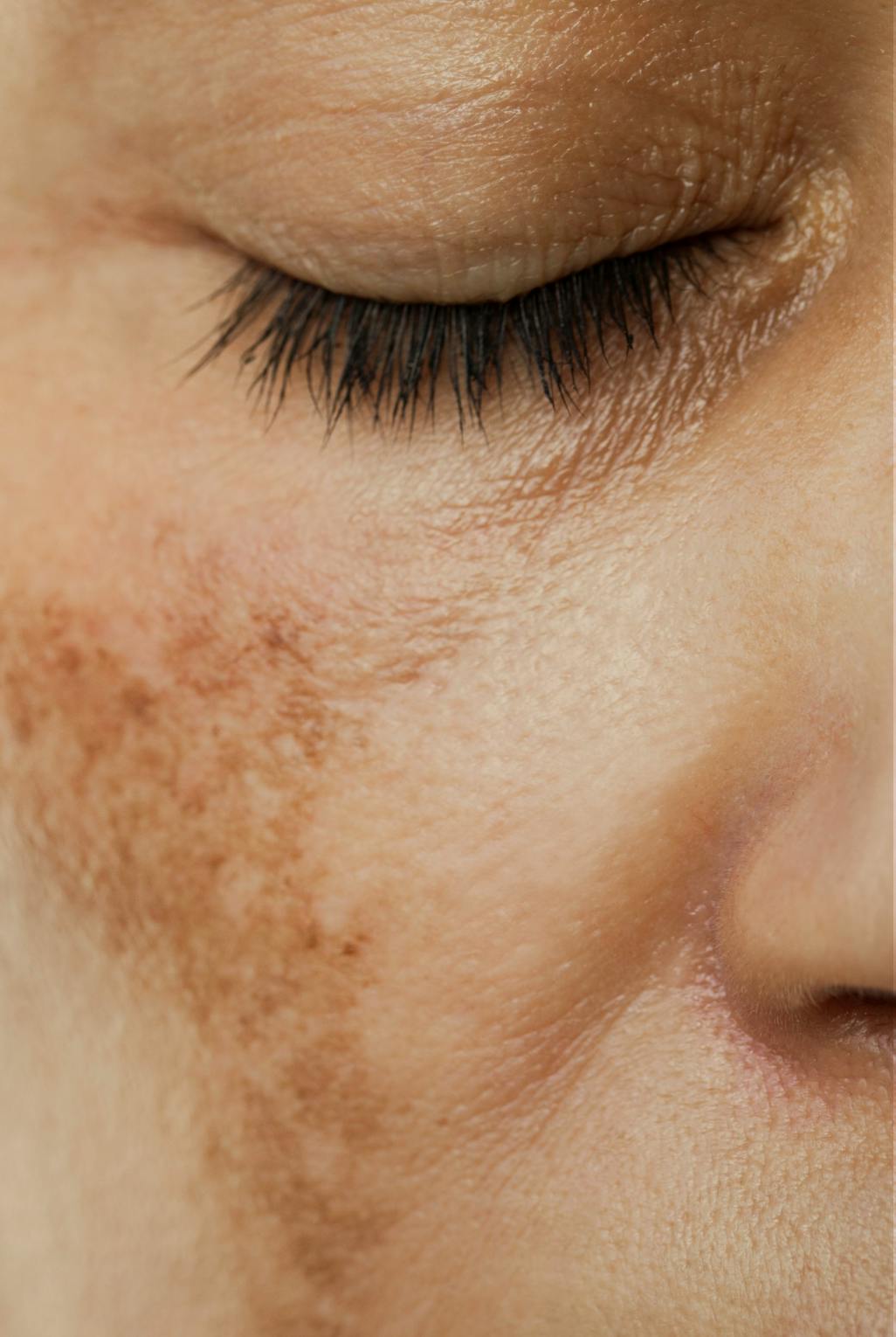 close up of a woman with sun spots on her face