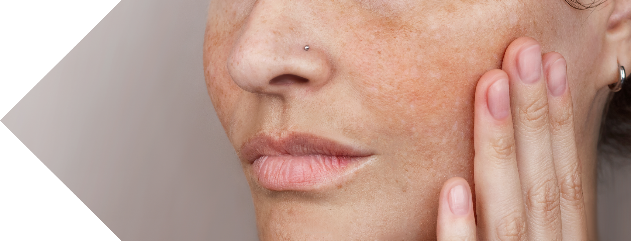 woman with sun spots on her cheek