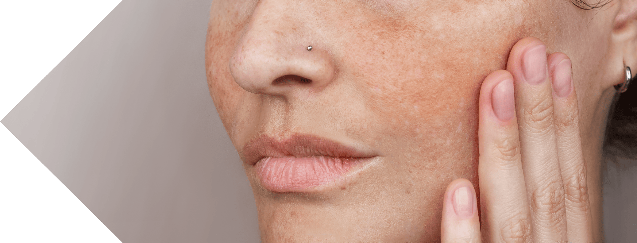 woman with sun spots on her cheek