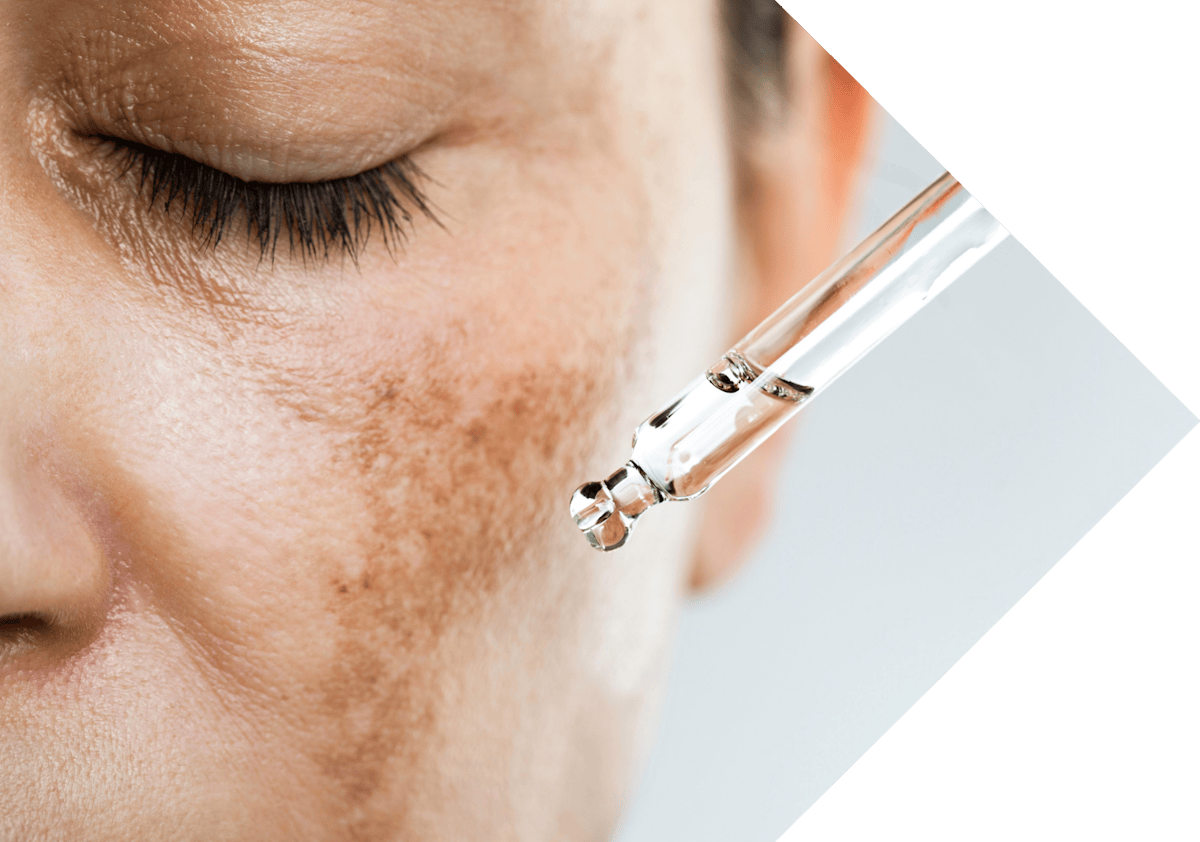 woman having treatment on her sun spots