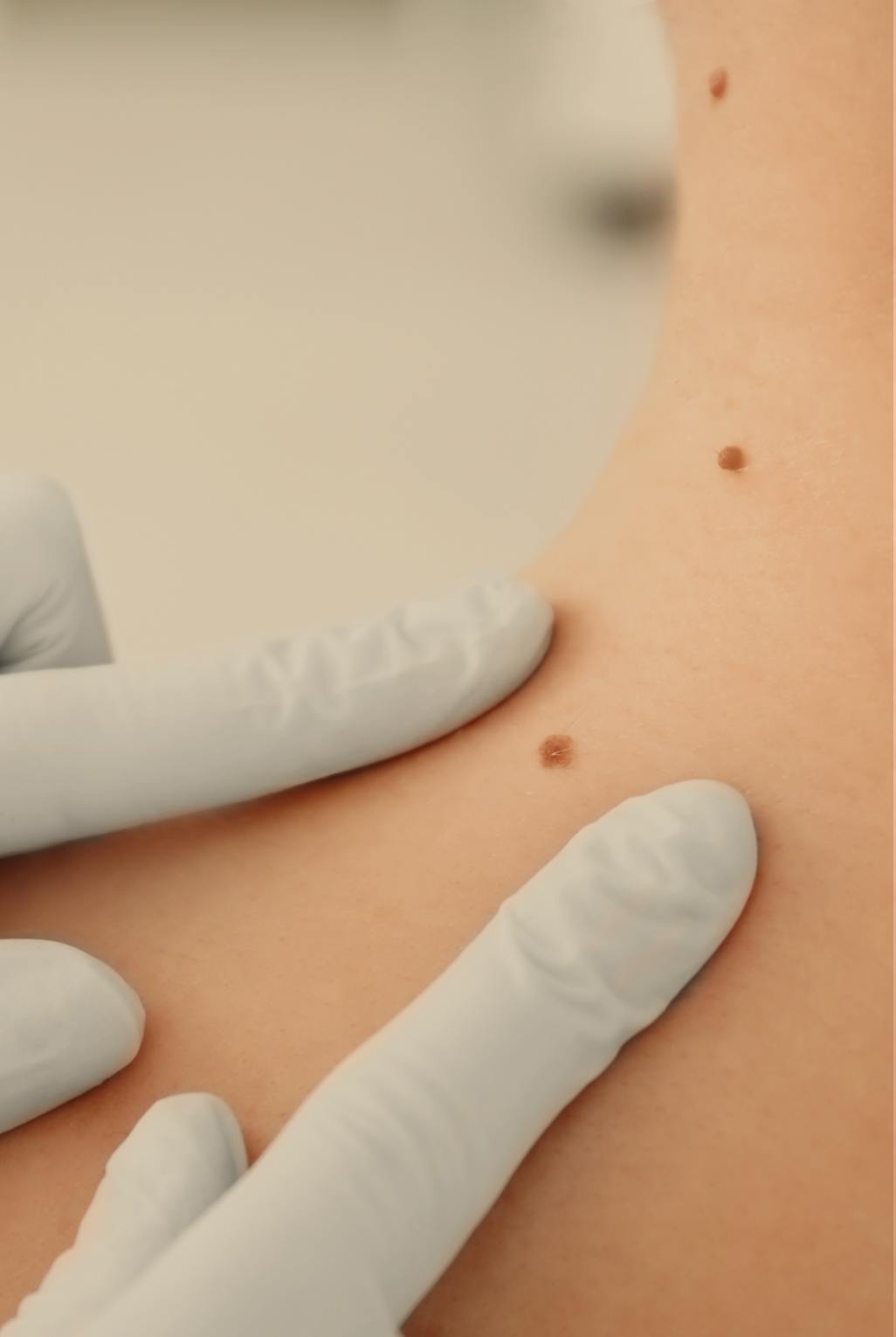 woman having her moles examined