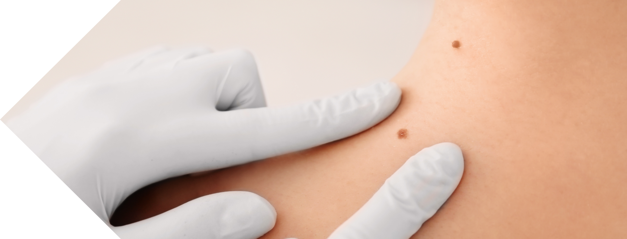woman having her moles examined