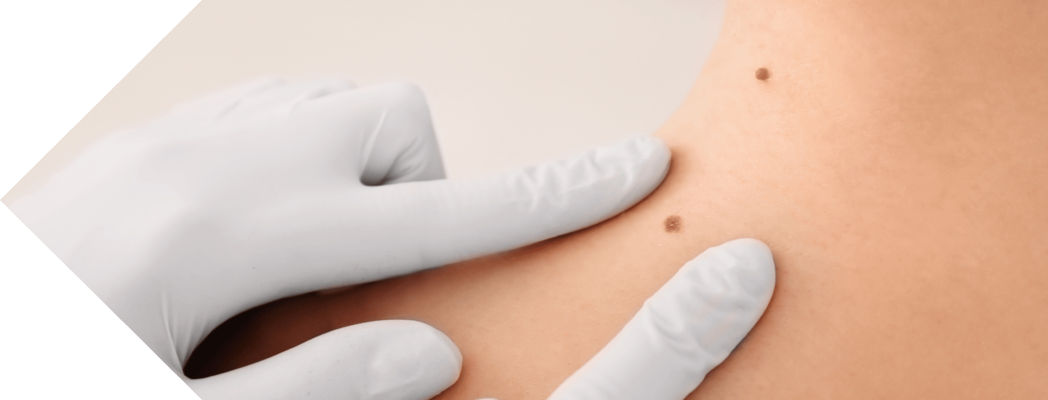 woman having her moles examined