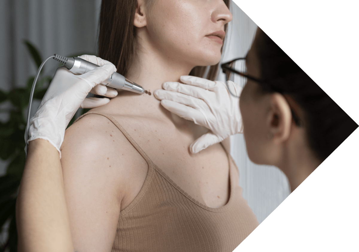 clinician treating moles with cryopen