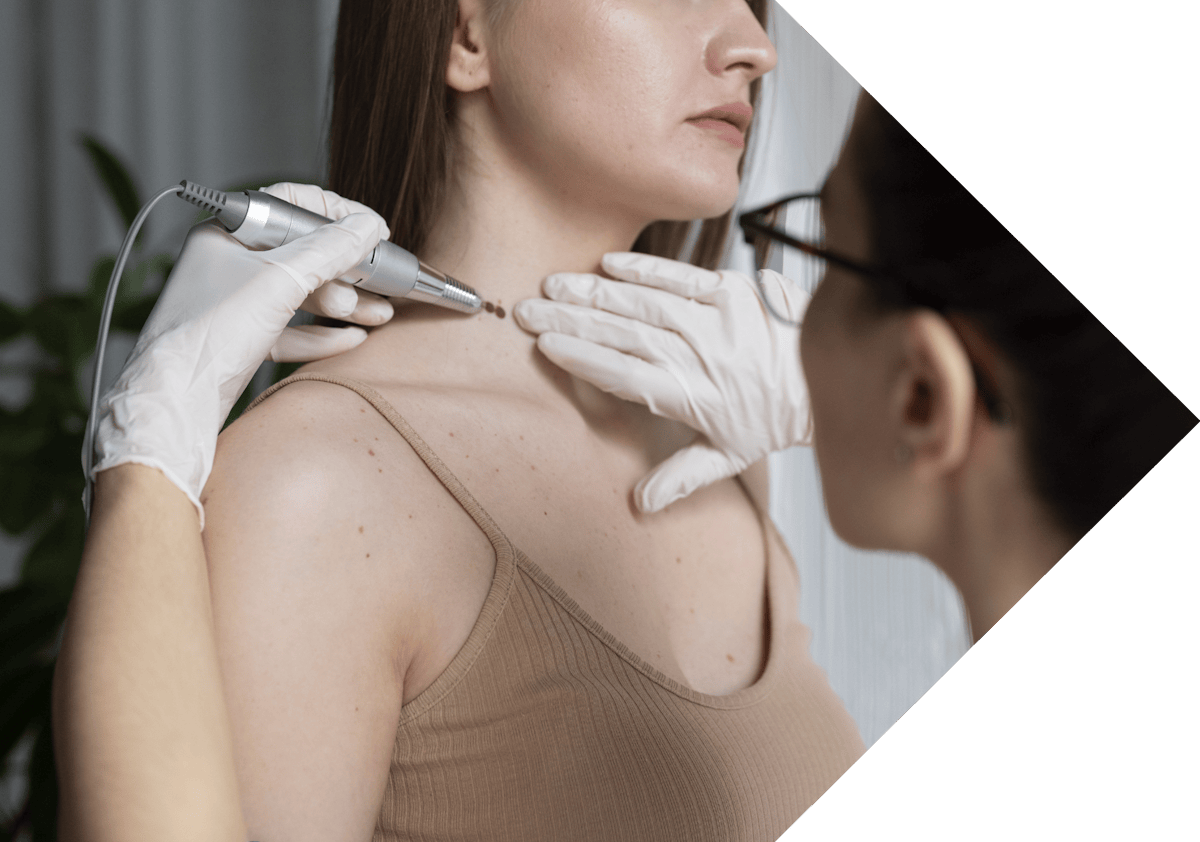 clinician treating moles with cryopen