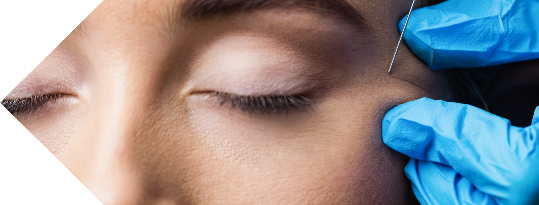 close up of a woman having anti wrinkle injection treatment