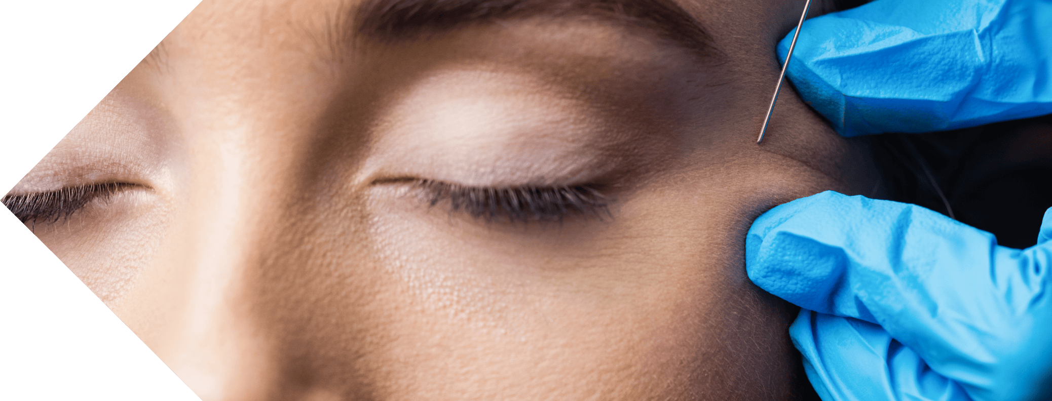 close up of a woman having anti wrinkle injection treatment