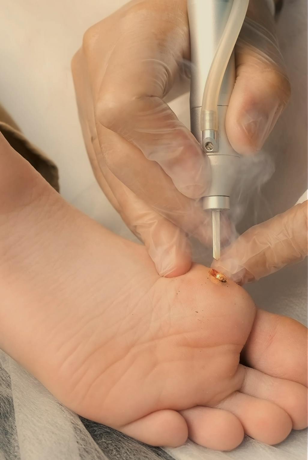 verrucca being removed from a foot