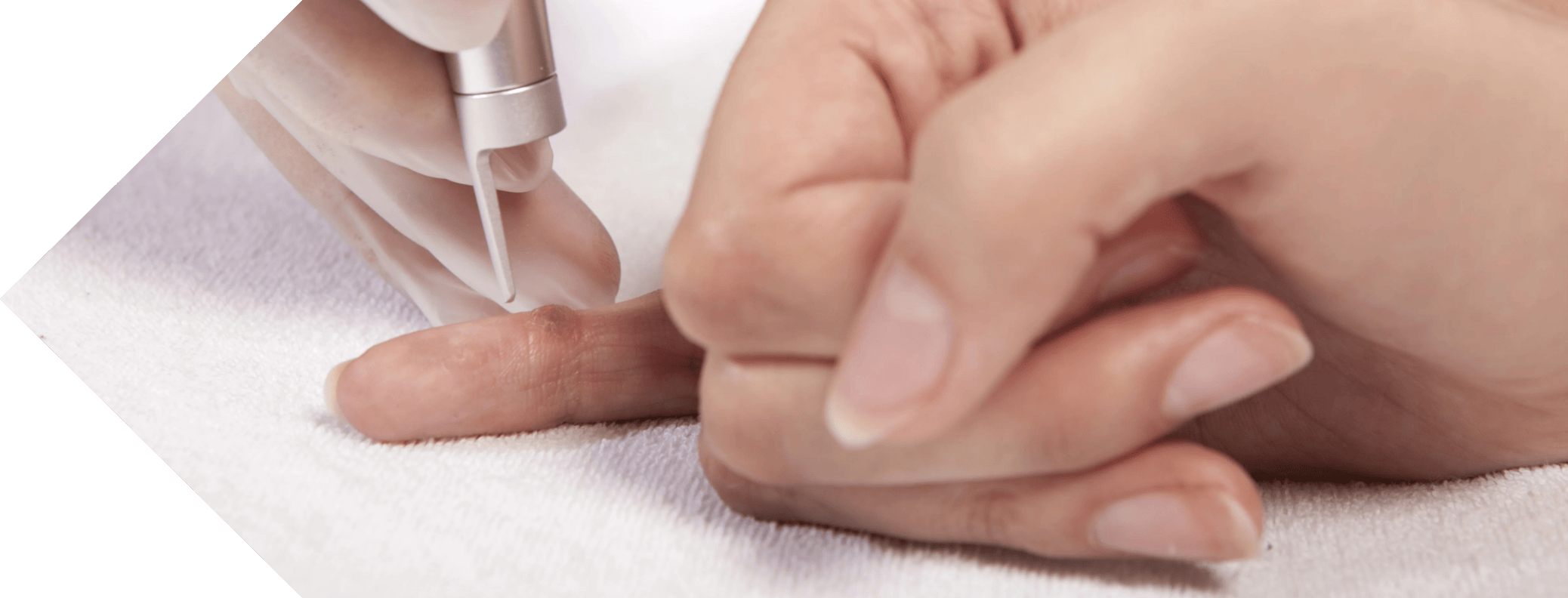 close up of a verrucca being treated