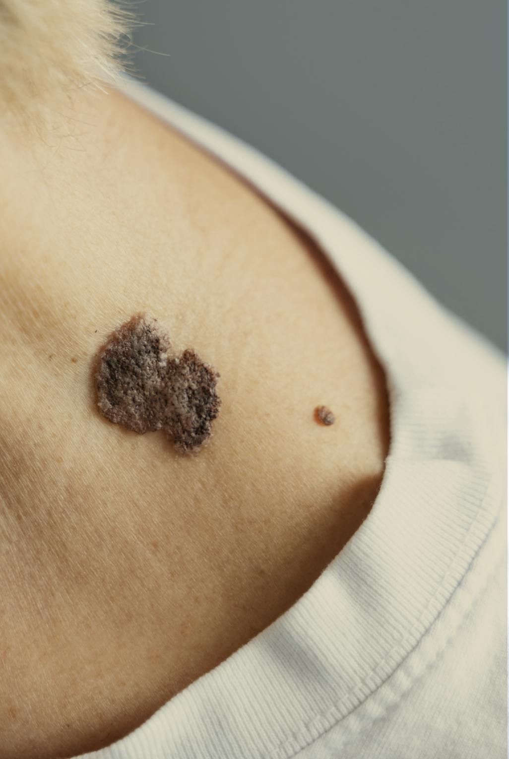 woman with Seborrhoeic Keratosis on her neck