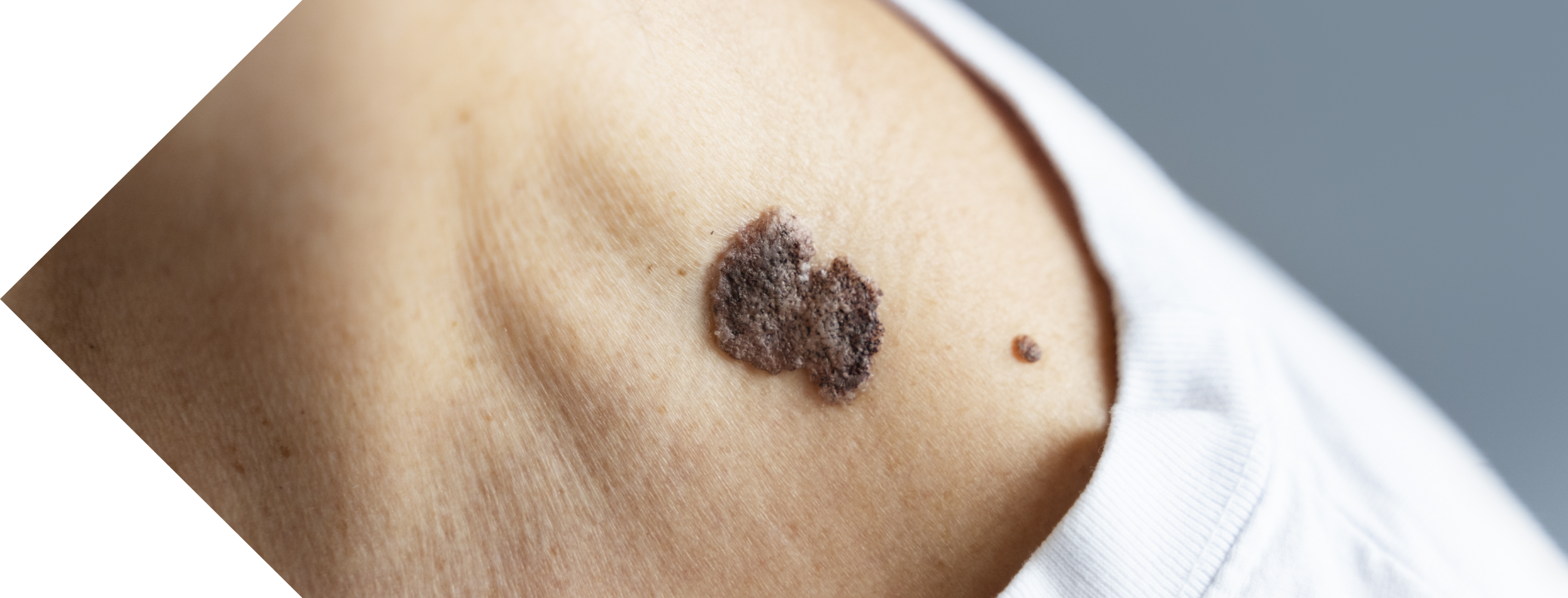 close up of a woman with Seborrhoeic Keratosis on her neck