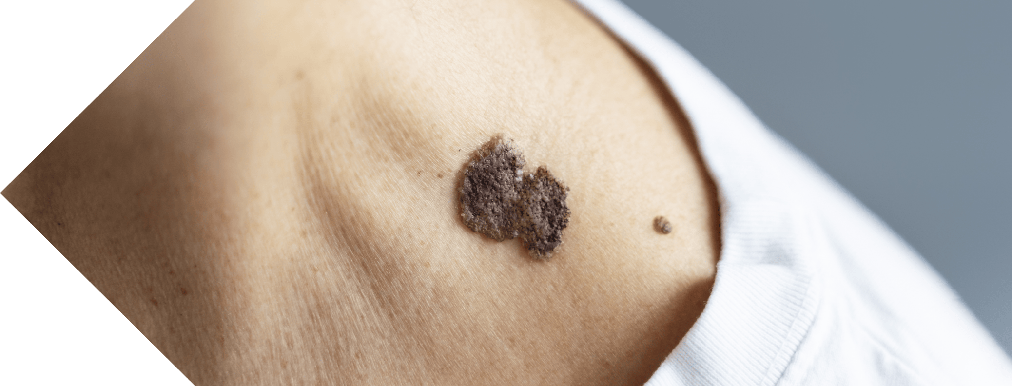 close up of a woman with Seborrhoeic Keratosis on her neck