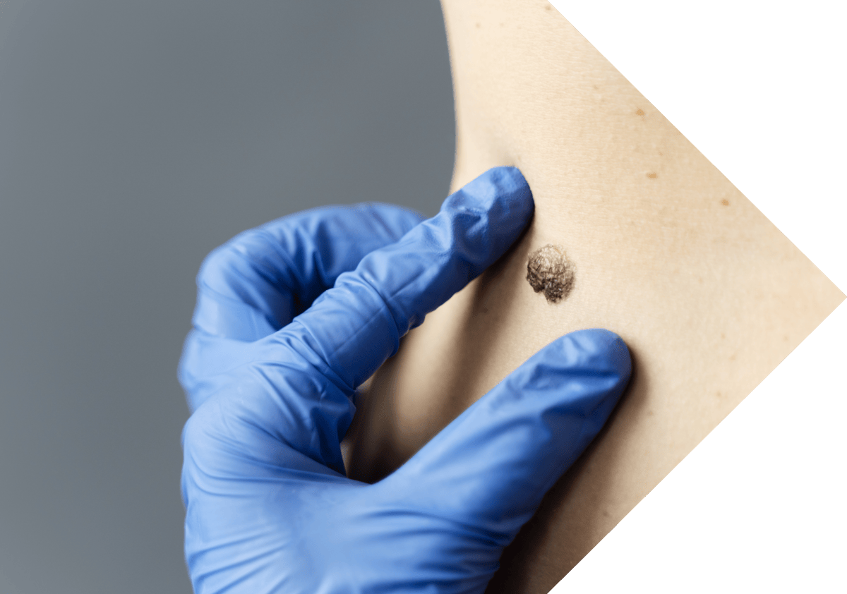 patient having Seborrhoeic Keratosis examined