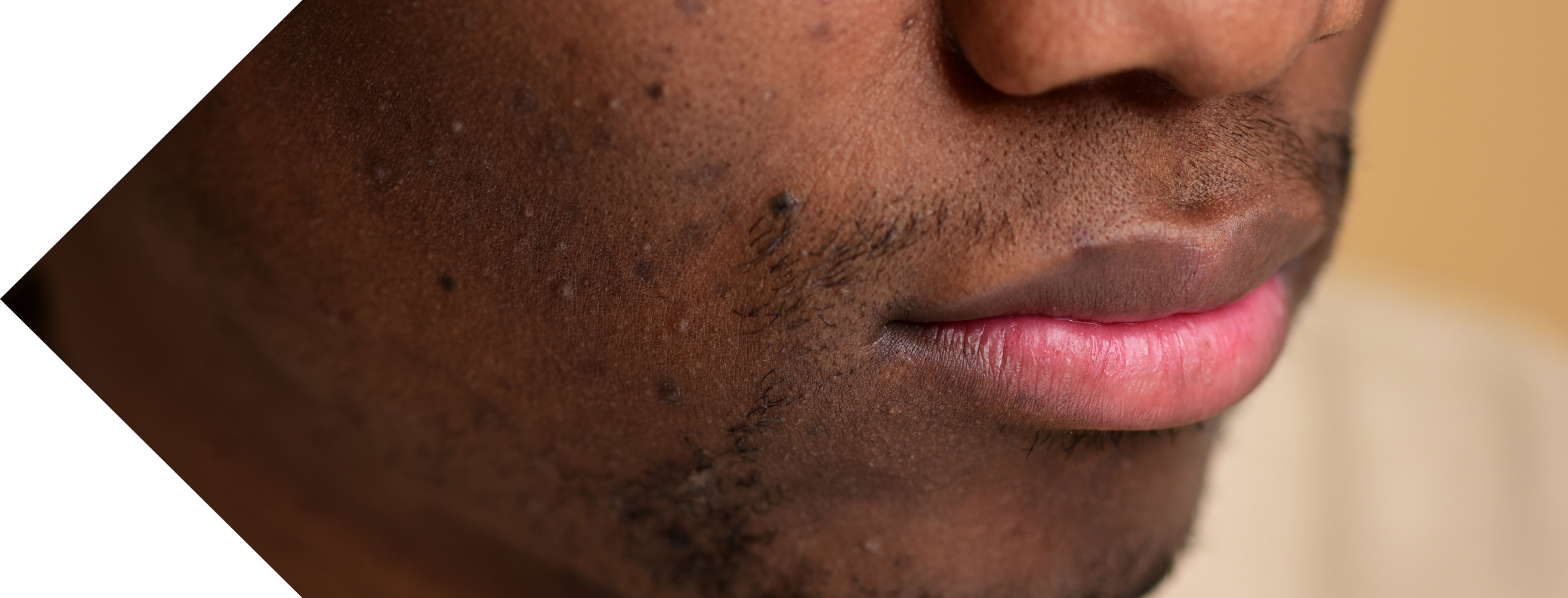 black man with Dermatosis Papulosa Nigra on his face