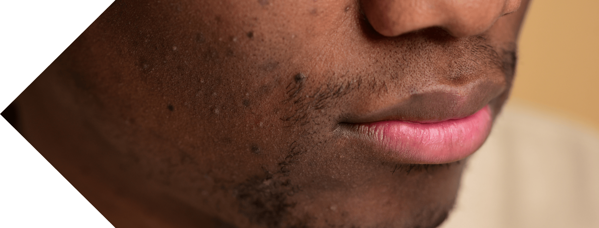 black man with Dermatosis Papulosa Nigra on his face