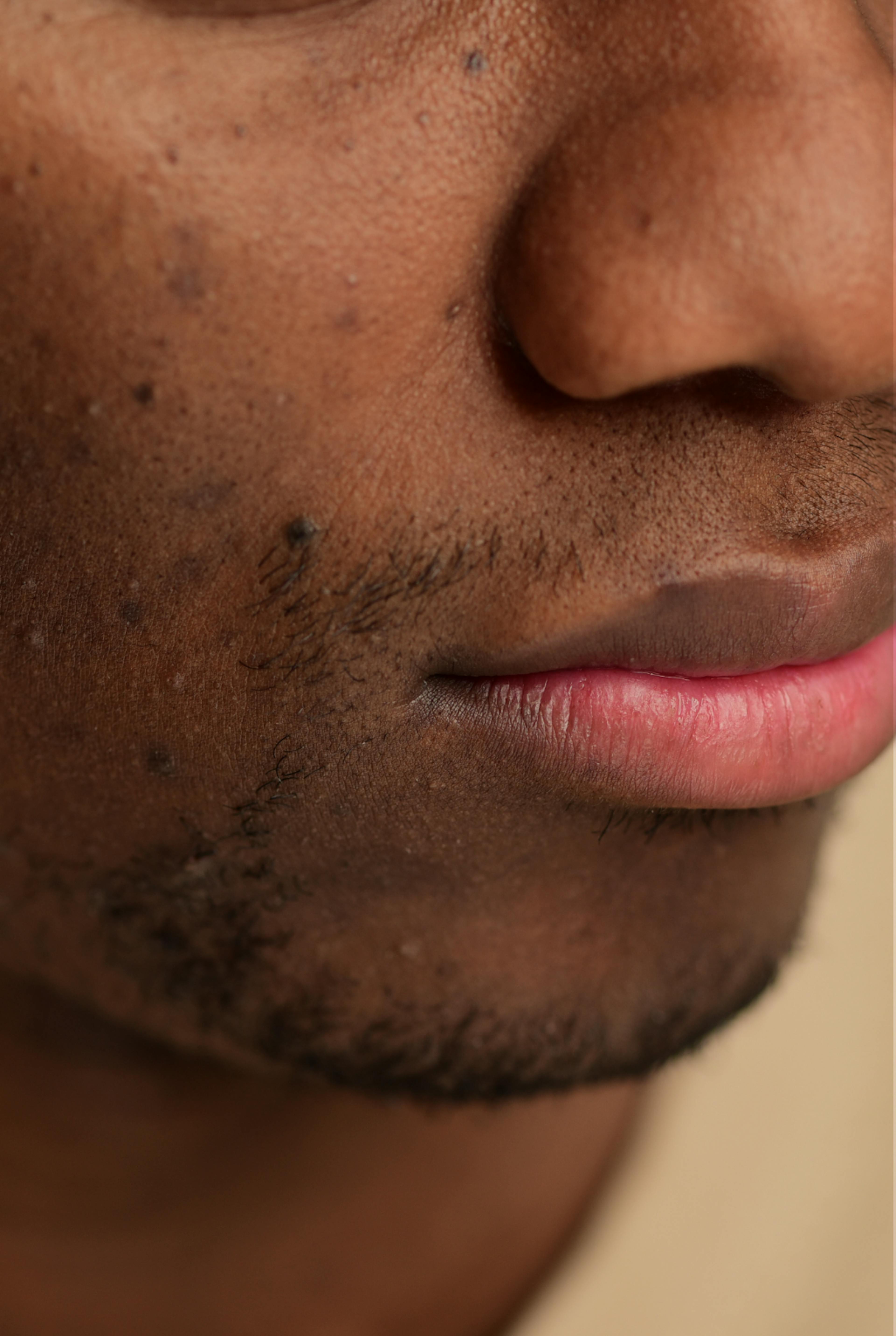 black man with Dermatosis Papulosa Nigra on his face