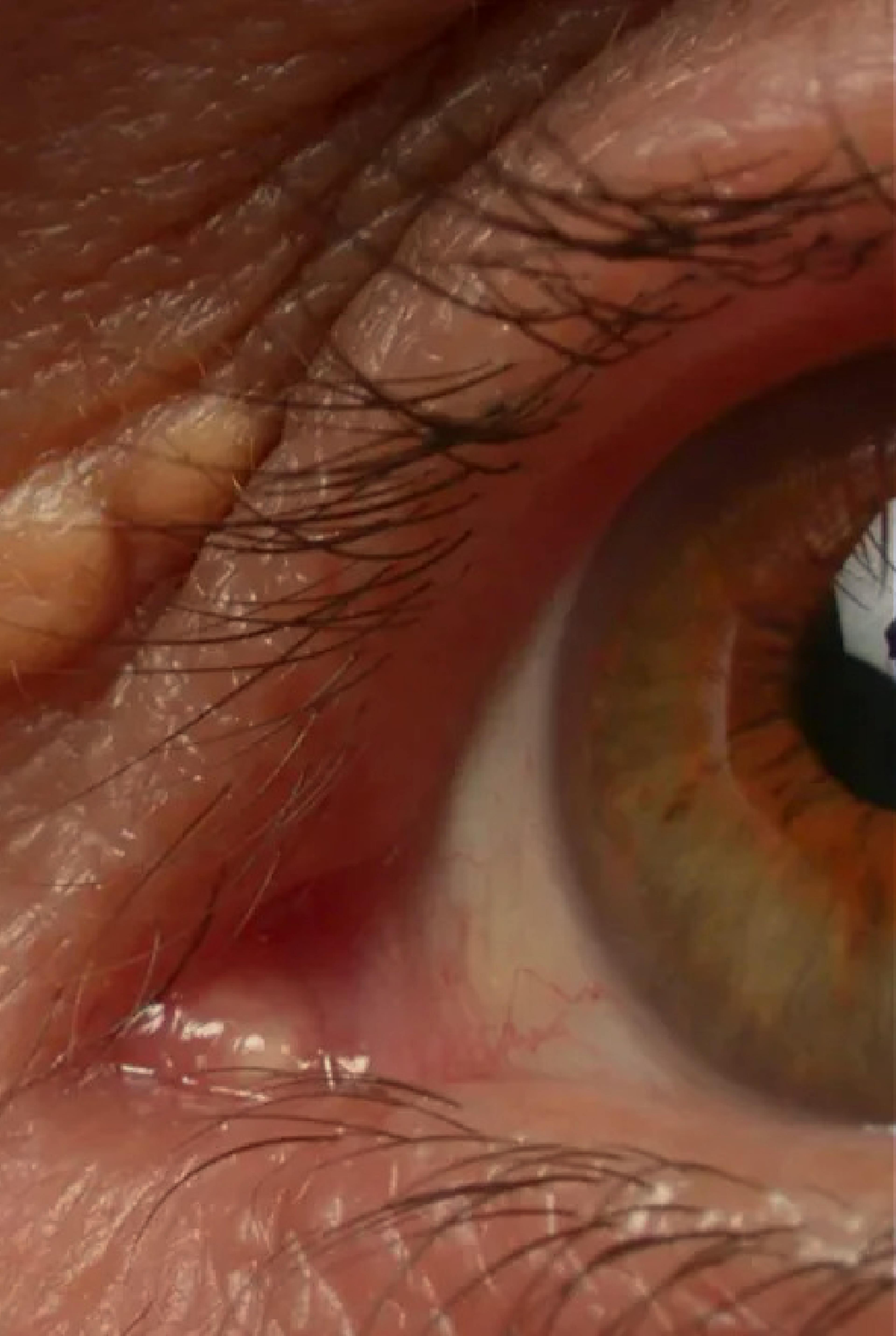 close up of an eye with Xanthelasma