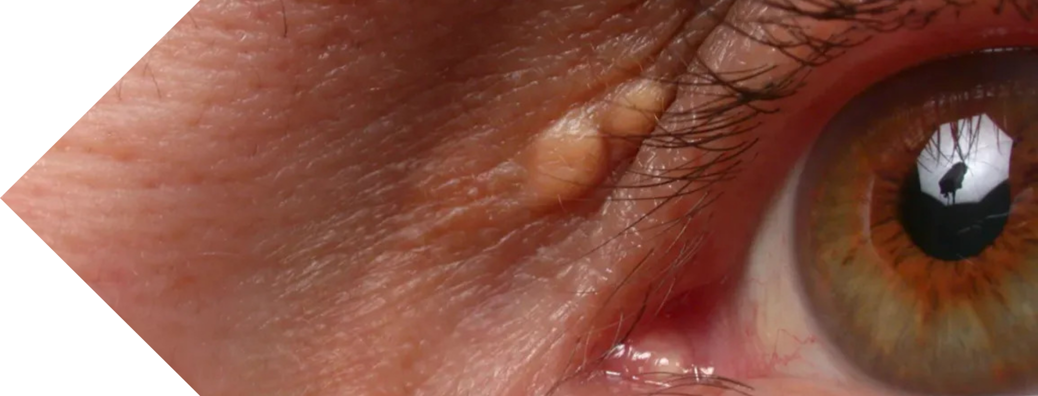 close up of an eye with Xanthelasma