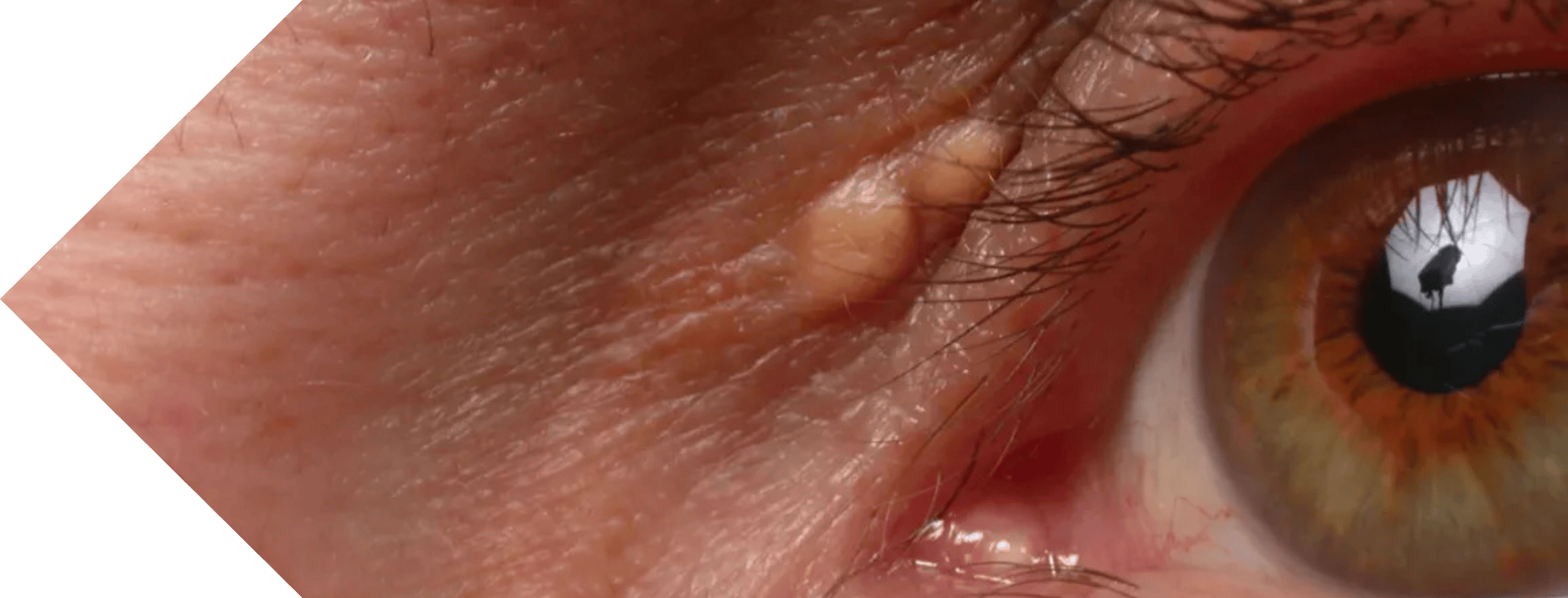 close up of an eye with Xanthelasma