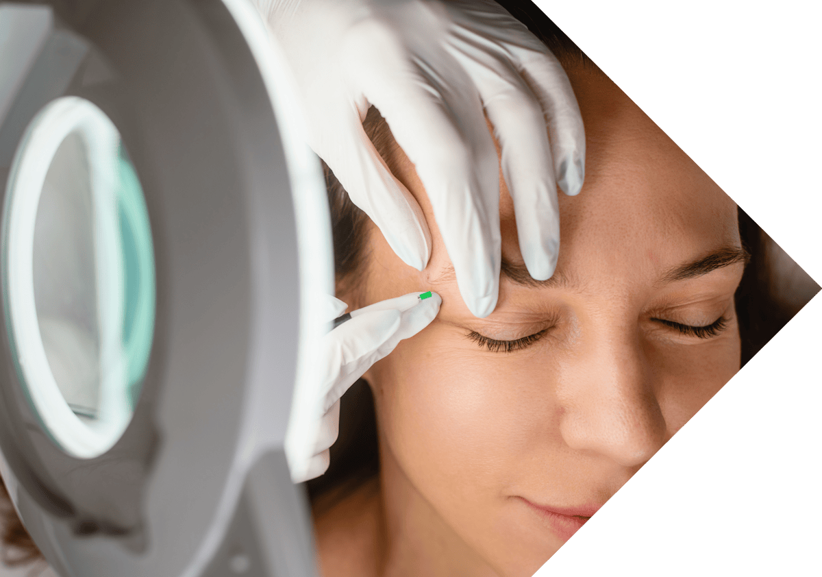 woman having Xanthelasma treatment