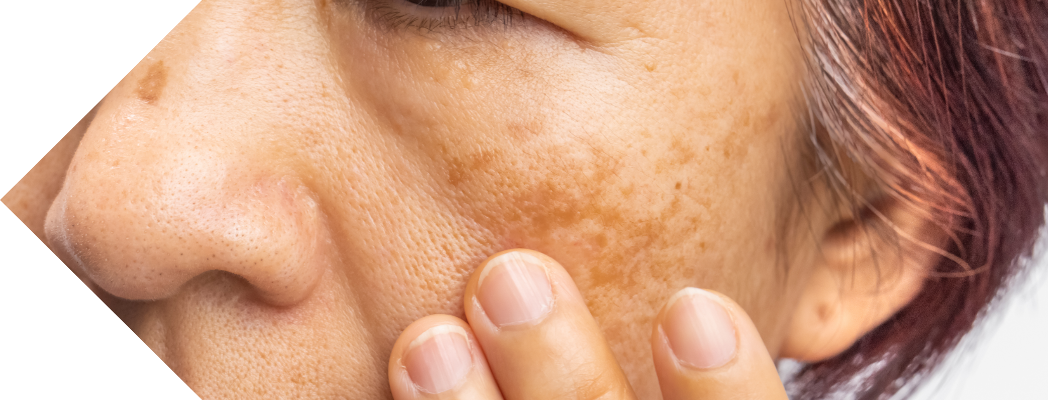 woman with age spots on her cheek