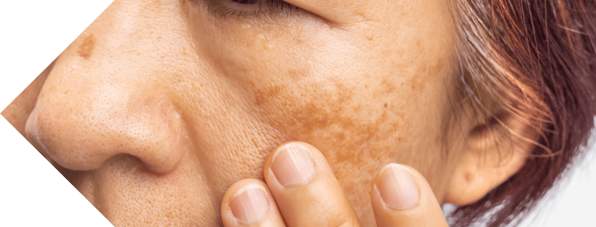 woman with age spots on her cheek