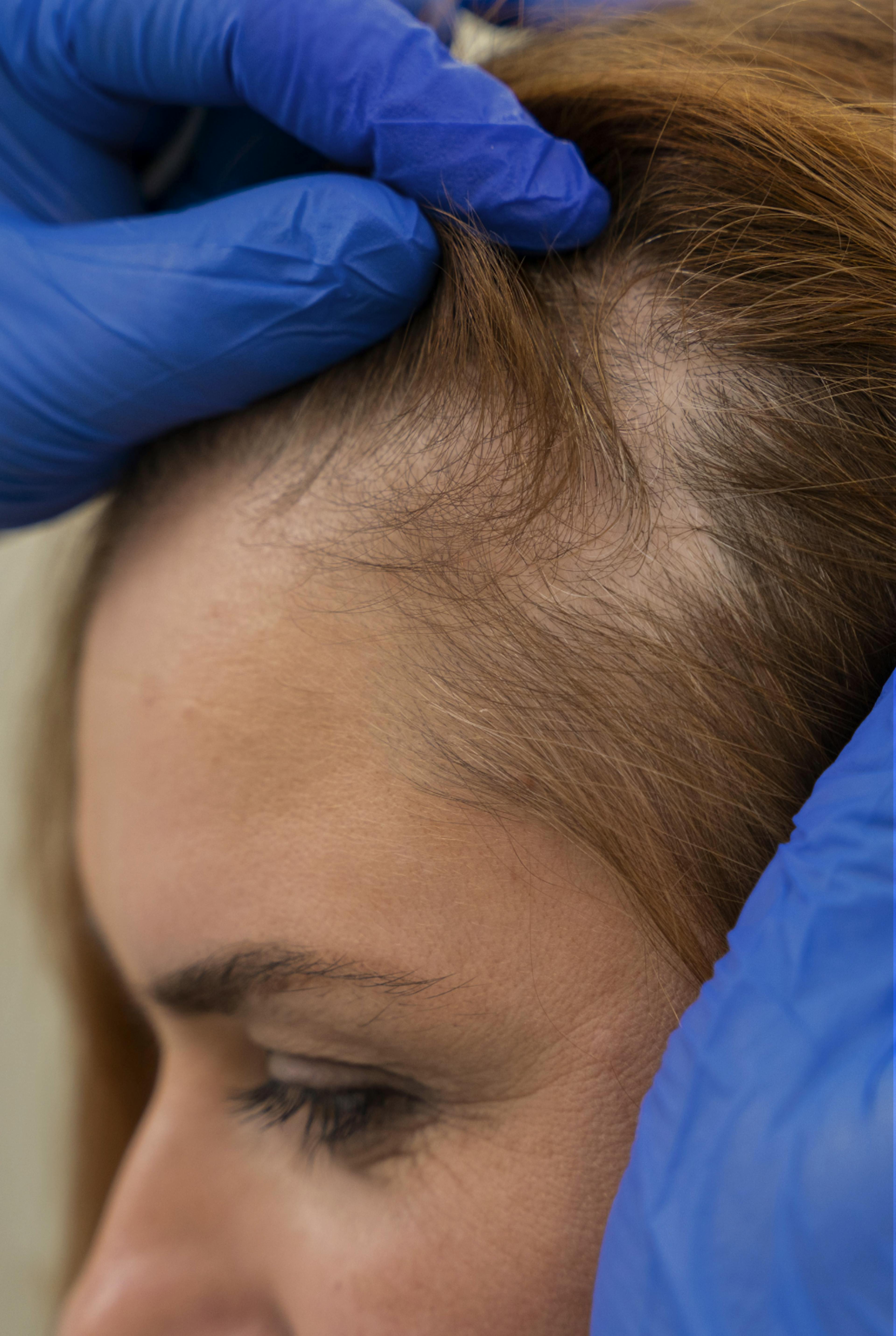 woman having her Pilar Cyst examined