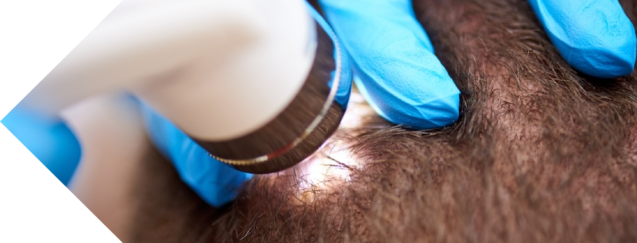 close up of Pilar Cyst treatment