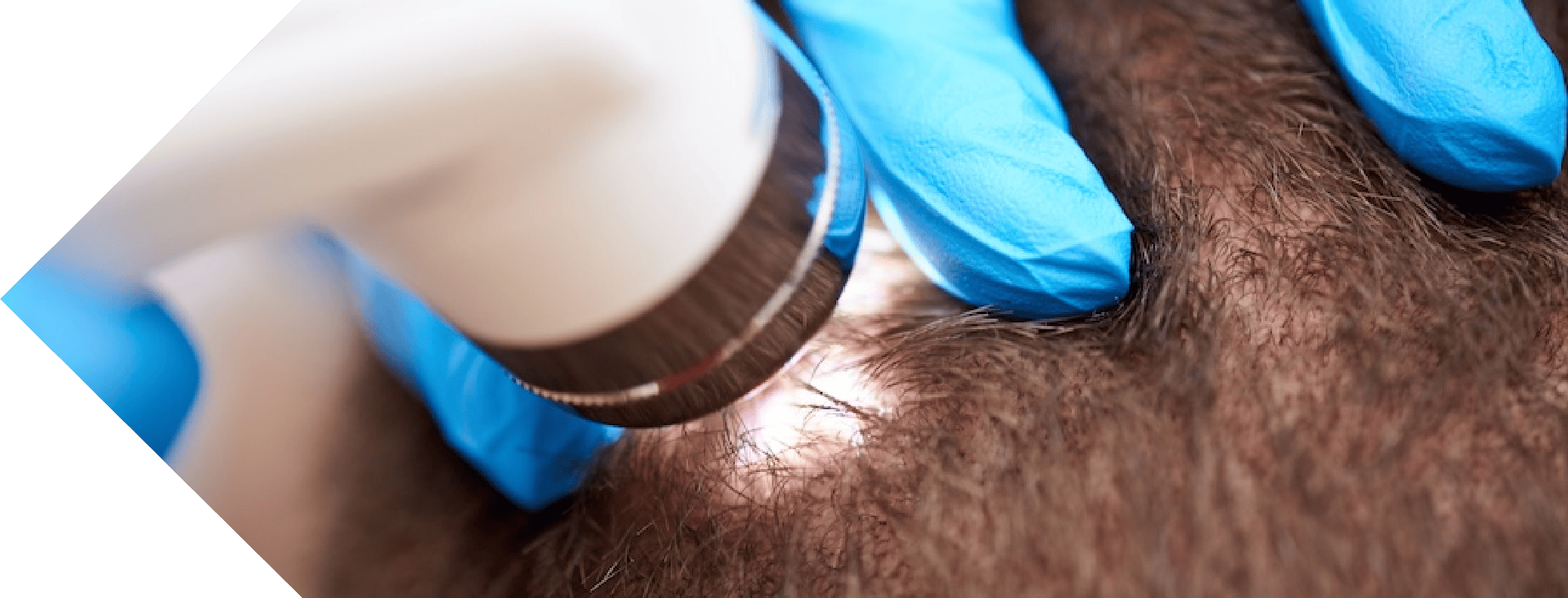 close up of Pilar Cyst treatment