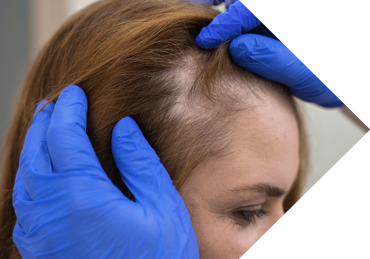 woman having her Pilar Cyst examined