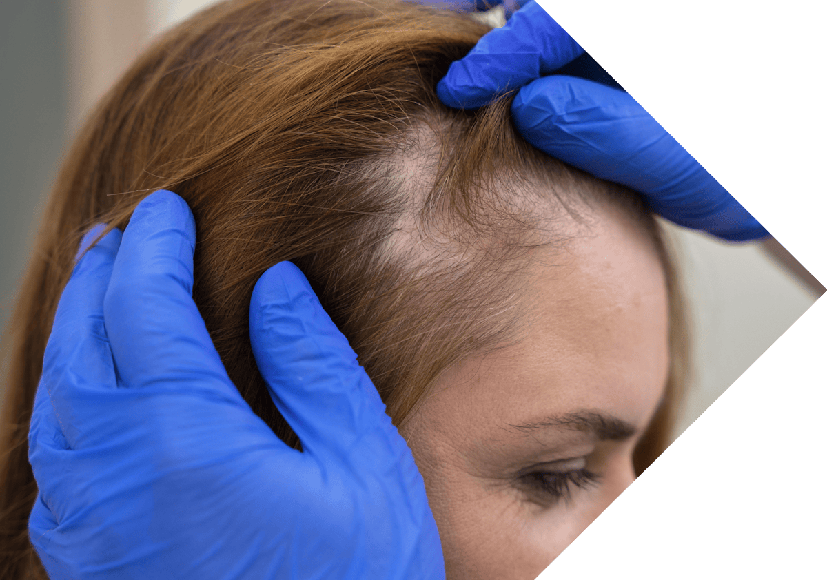 woman having her Pilar Cyst examined