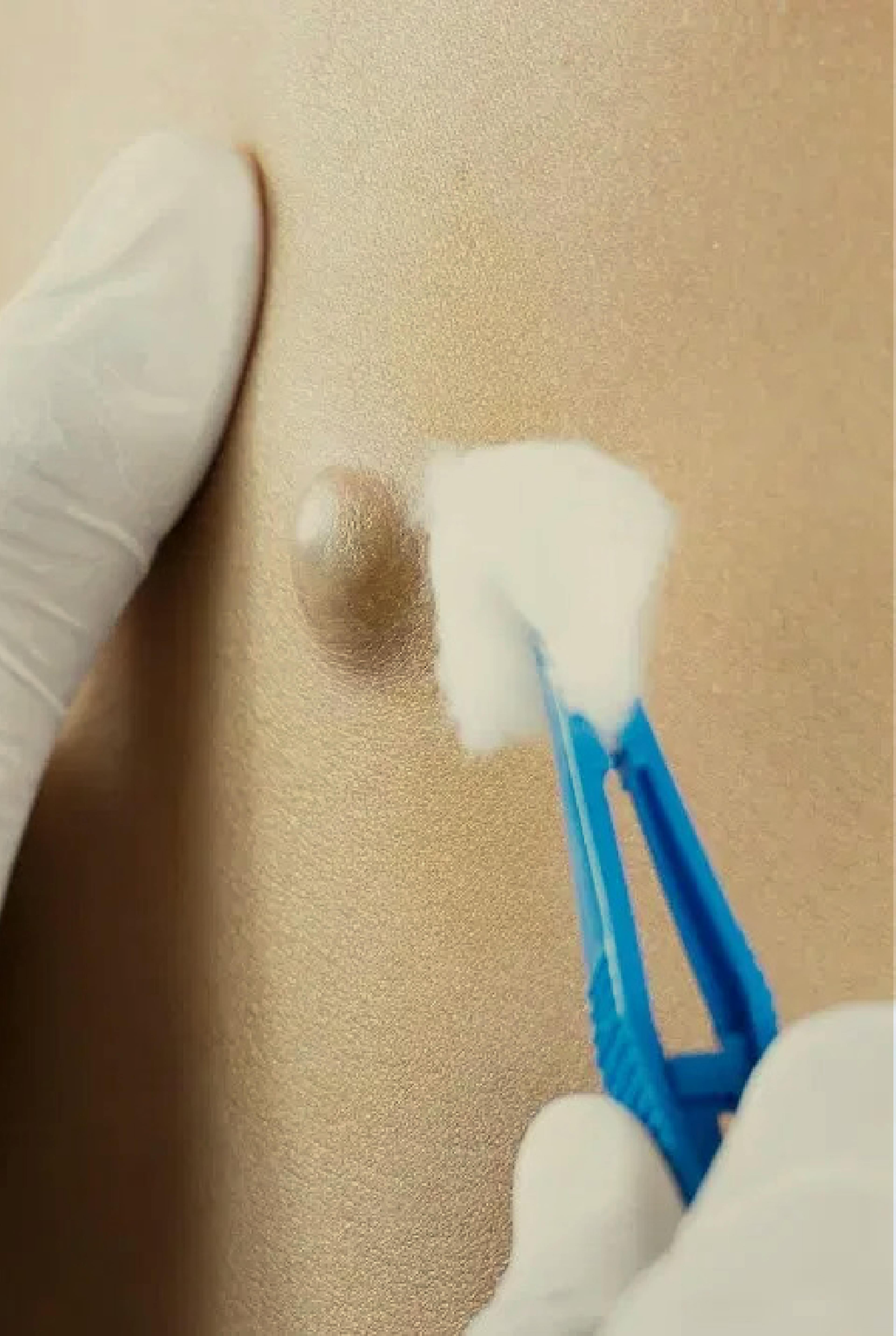 close up of a Sebaceous Cyst being treated