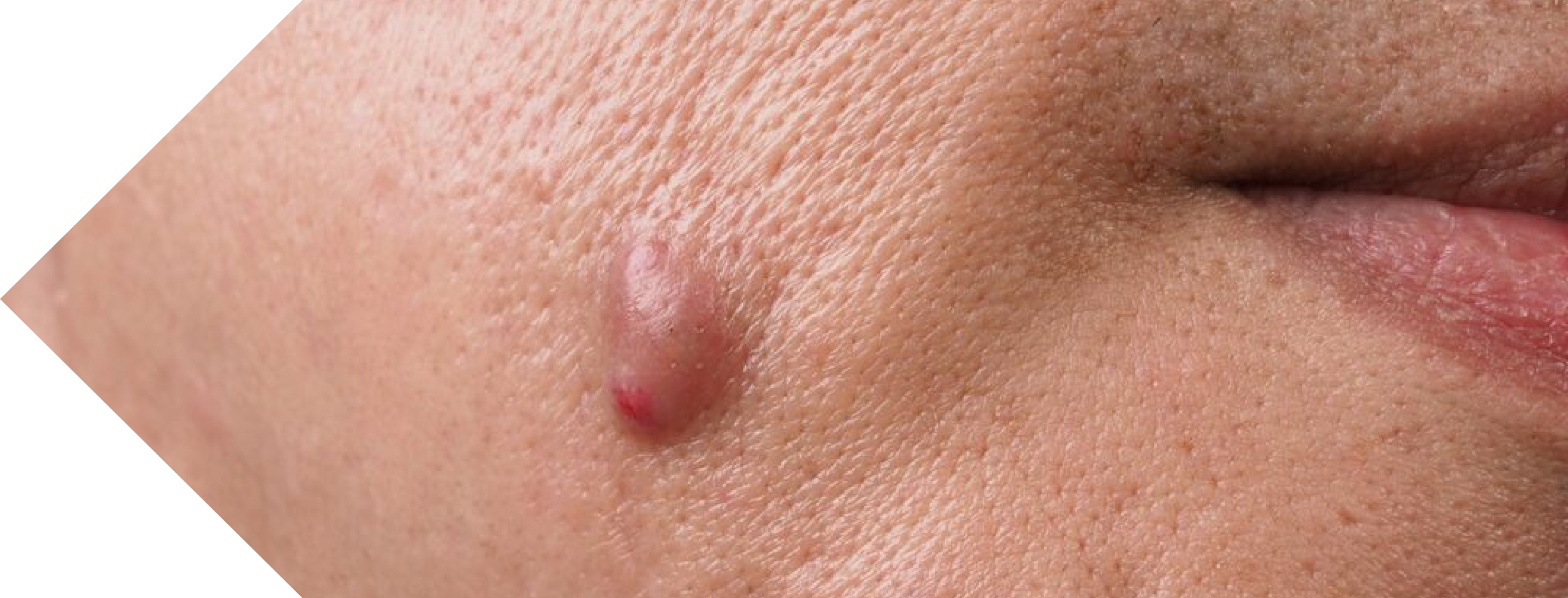 Sebaceous Cyst on a womans face