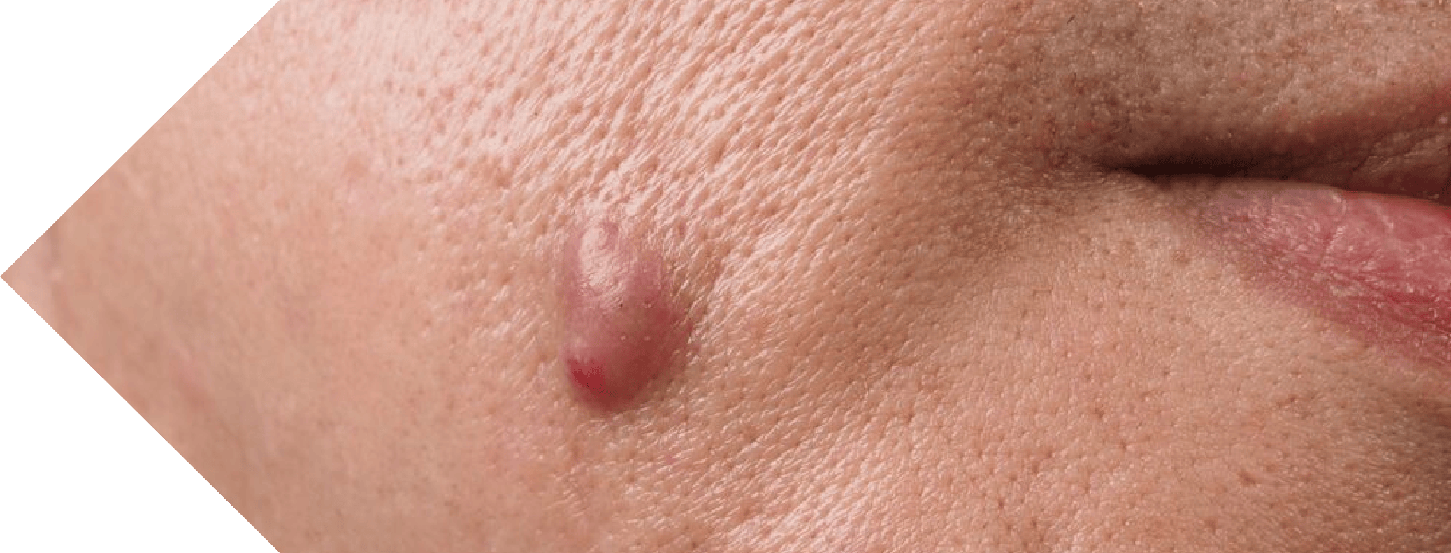 Sebaceous Cyst on a womans face