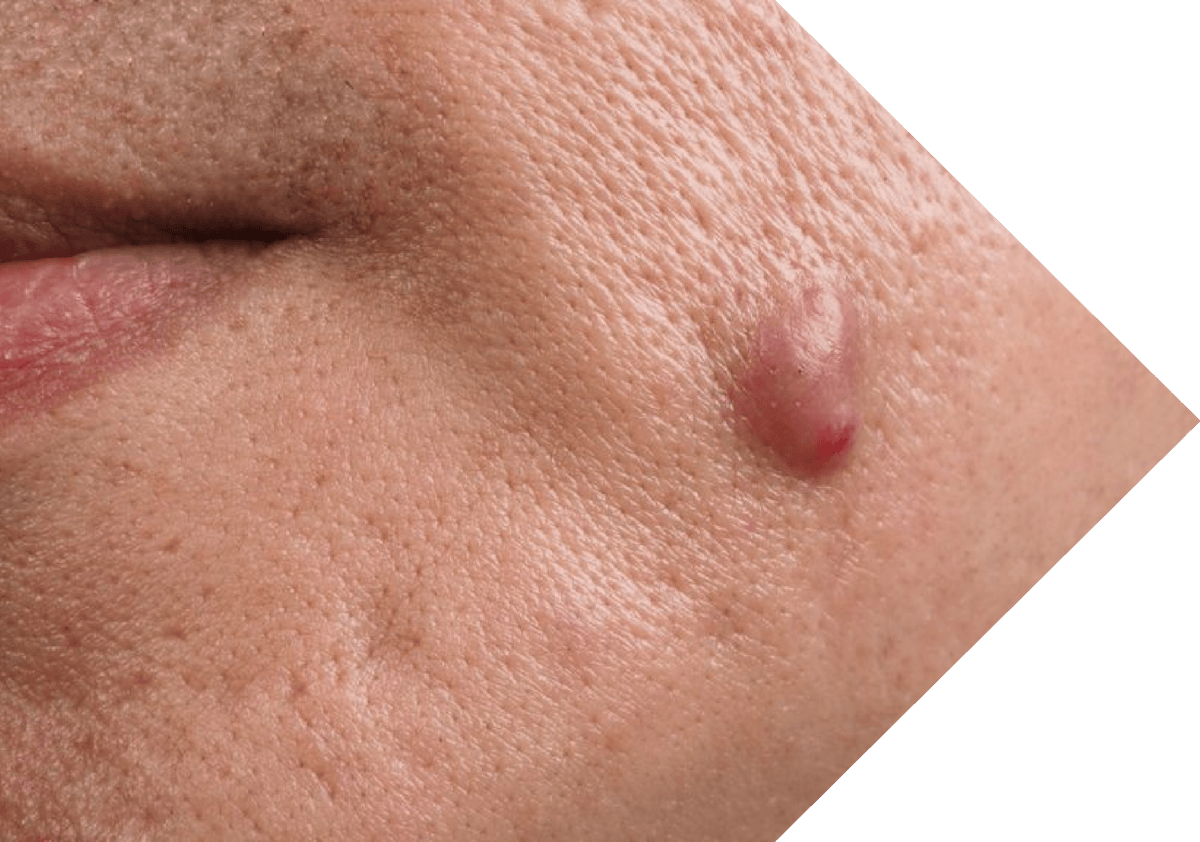 Sebaceous Cyst on a womans face