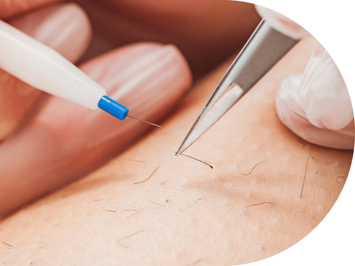 electrolysis hair removal being performed