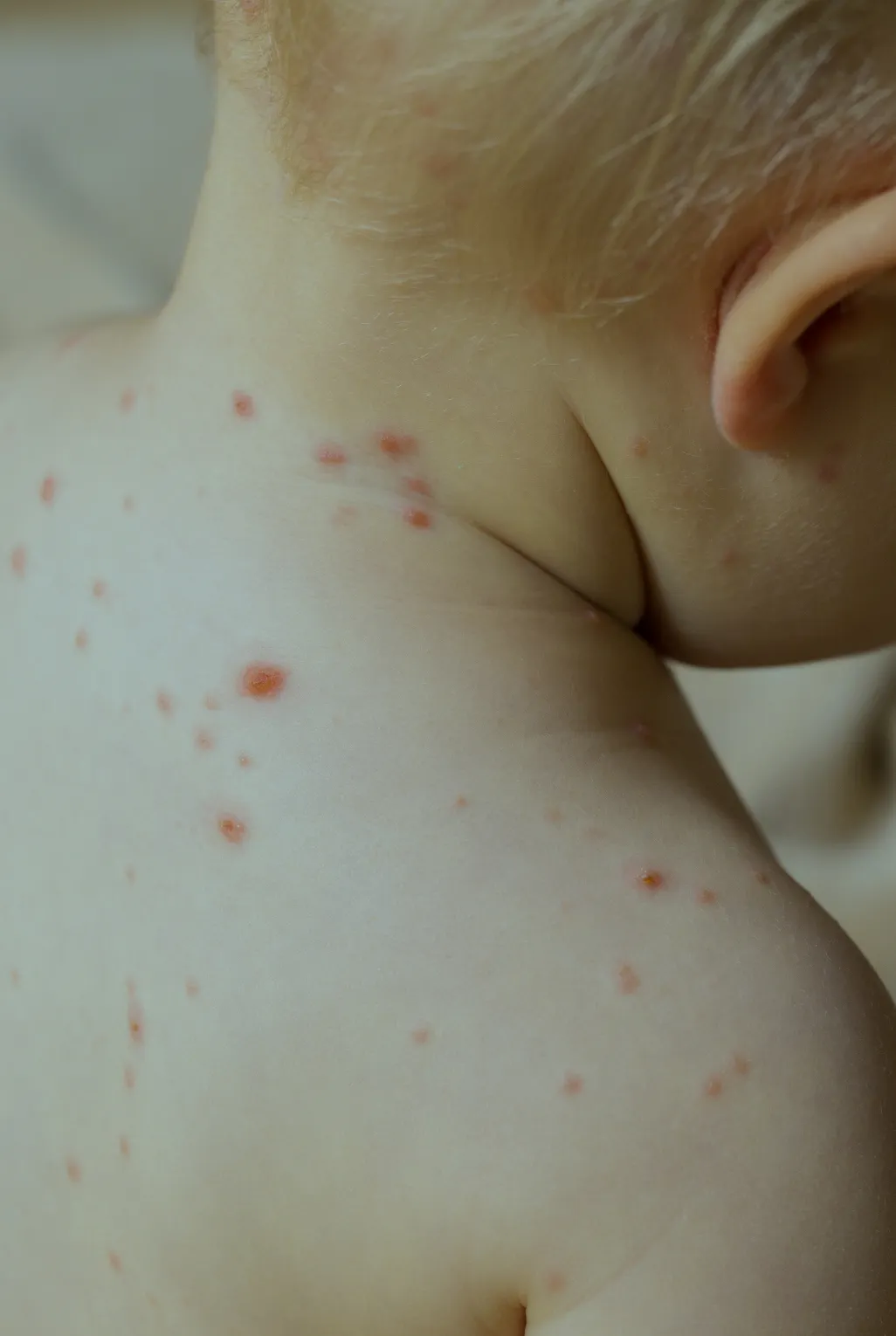 Child with chicken pox