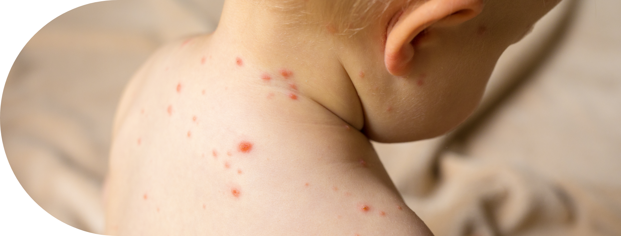 Child with chicken pox