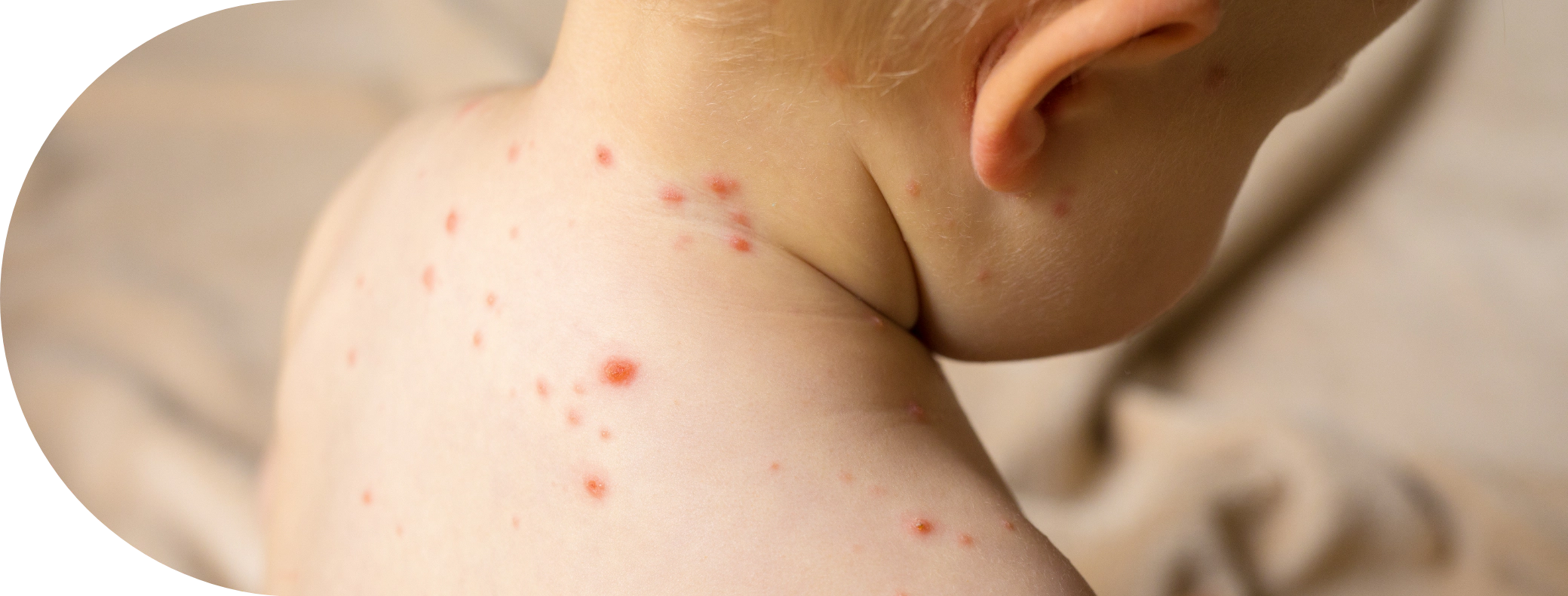 Child with chicken pox
