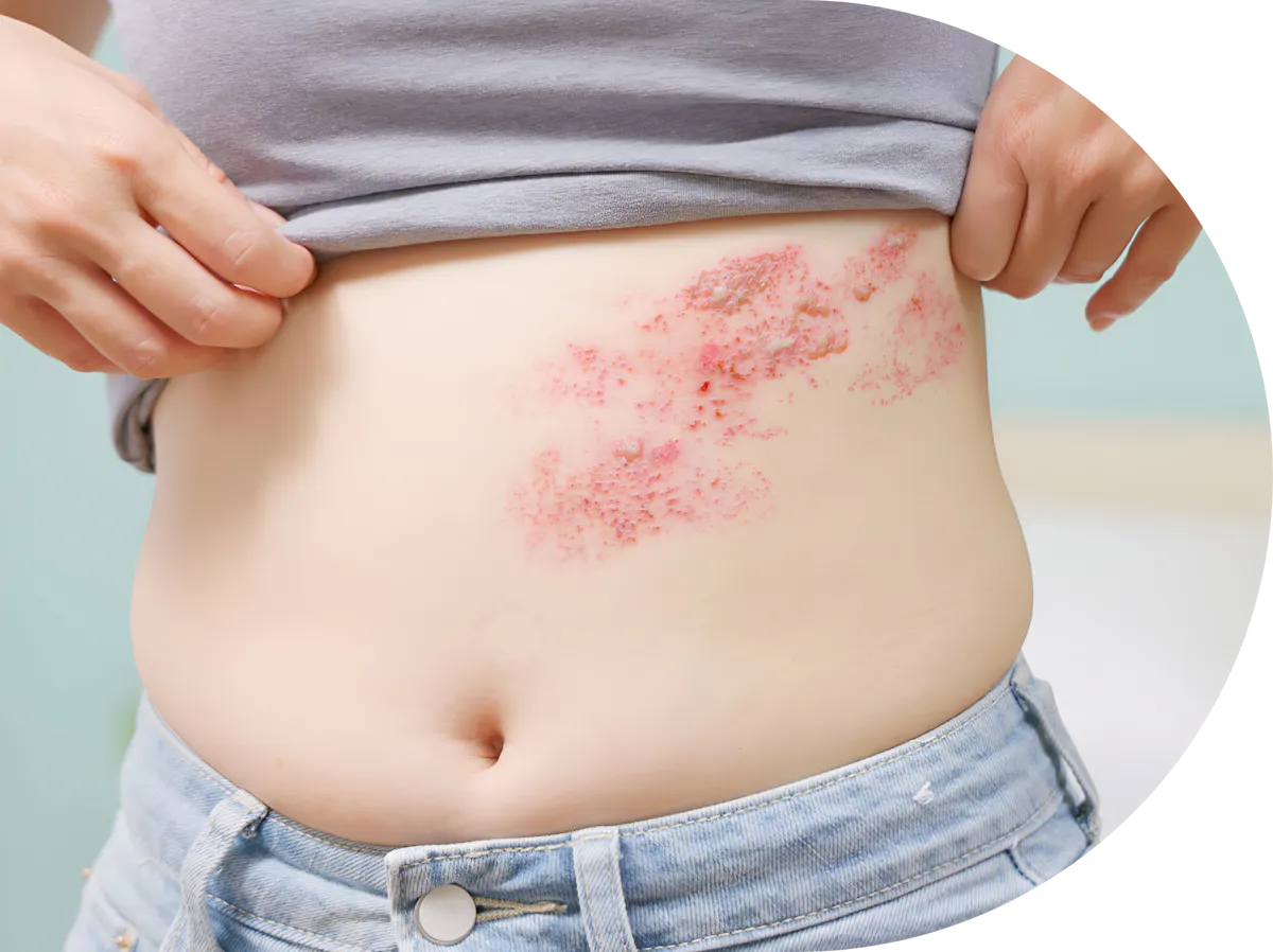 A woman with shingles
