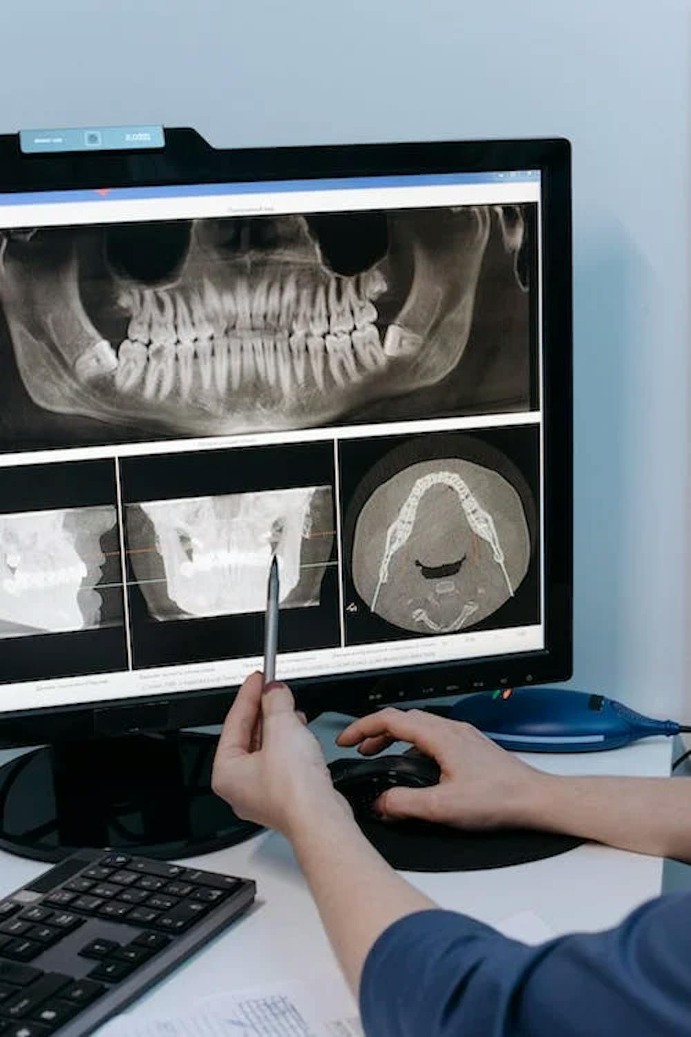 A full oral teeth X-ray report on computer pic
